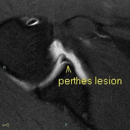 m2 perdos|Perthes lesion .